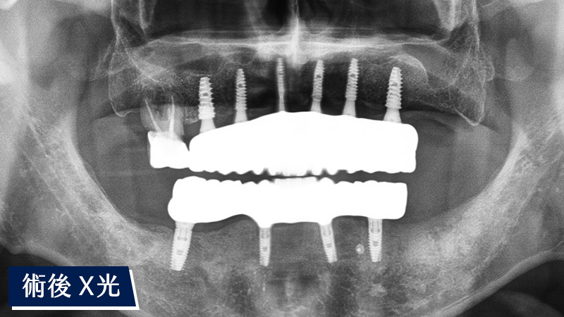 全口重建術後X光