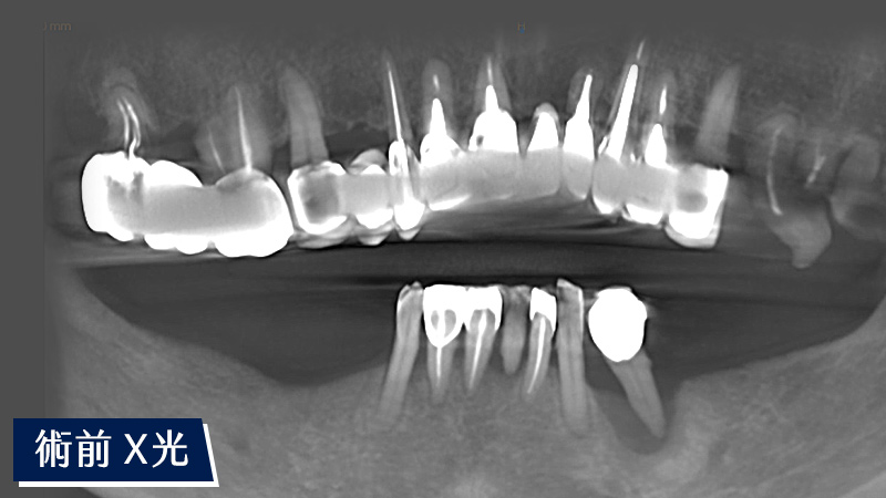 全口重建術前X光