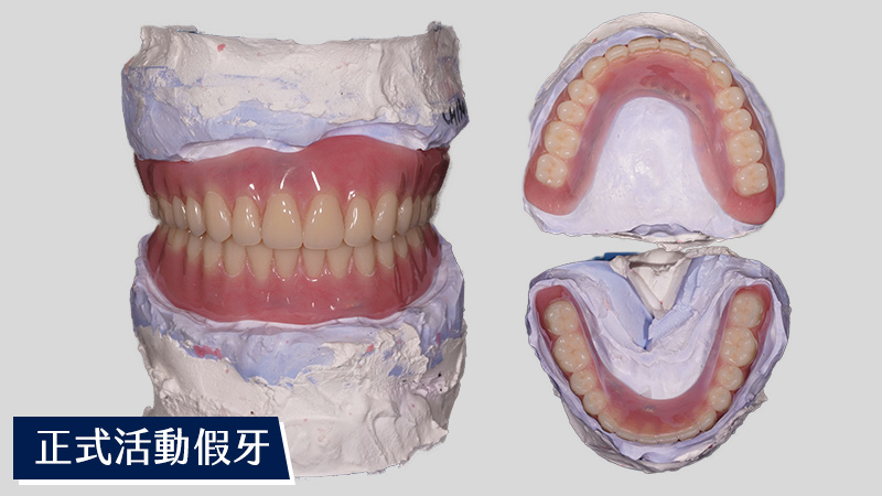 正式製作完成活動假牙