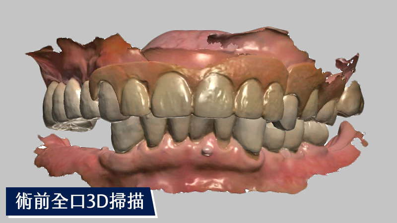 全口術前3D掃描