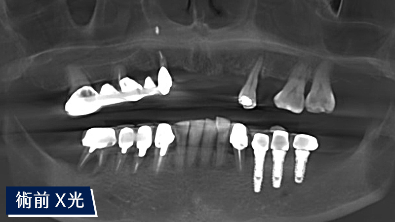 全口重建術前X光