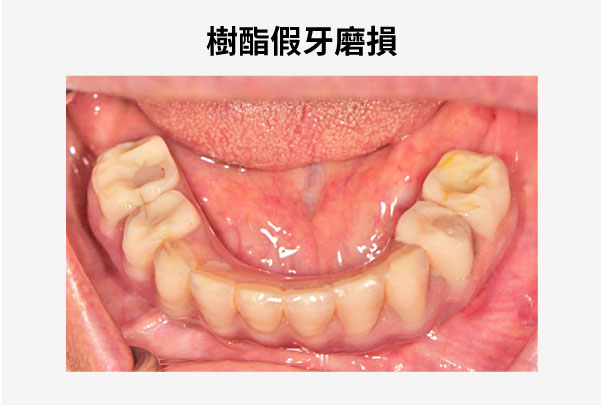 樹酯假牙易斷裂磨耗脫落