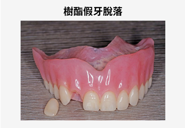 樹酯假牙易斷裂磨耗脫落