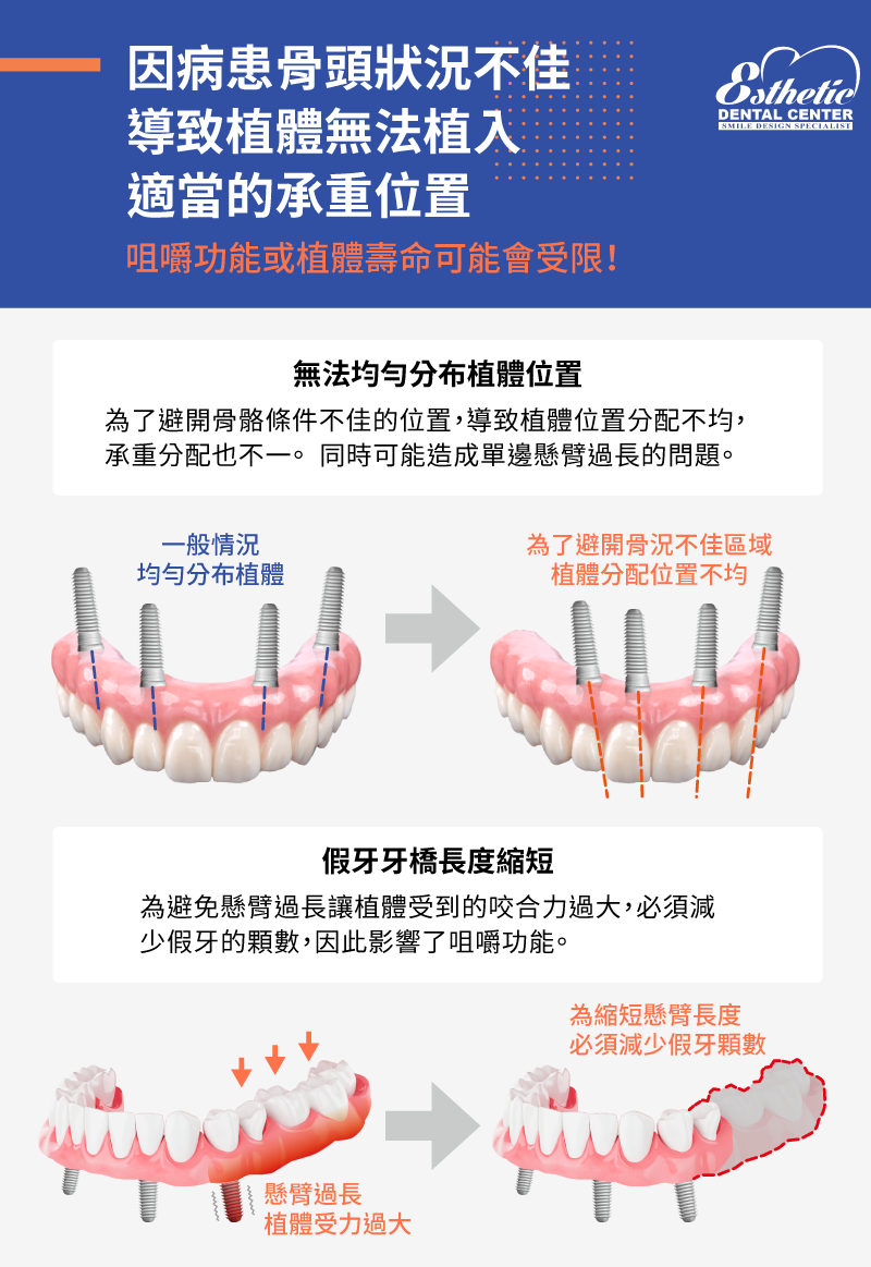 AllOn4懸臂過長分配不均