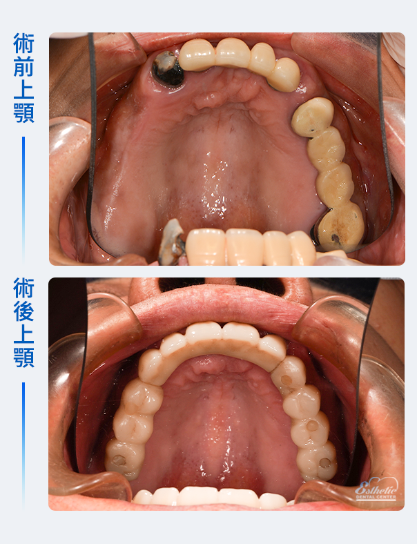 術前術後上顎