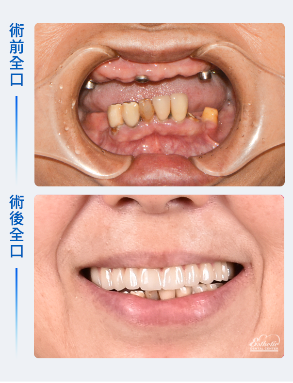權泓牙醫All-on-6重新打造穩固美麗的一口好牙