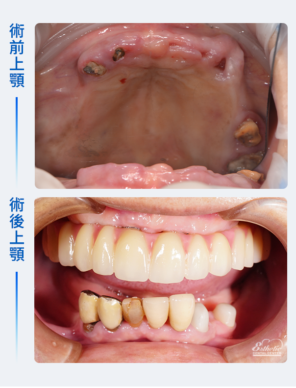 權泓牙醫All-on-6重新打造穩固美麗的一口好牙