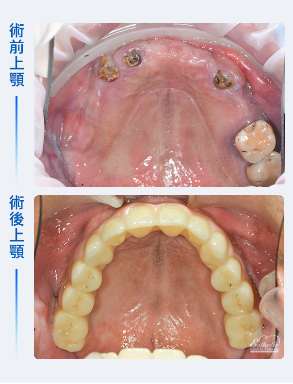 權泓牙醫All-on-6上顎固定式全口重建