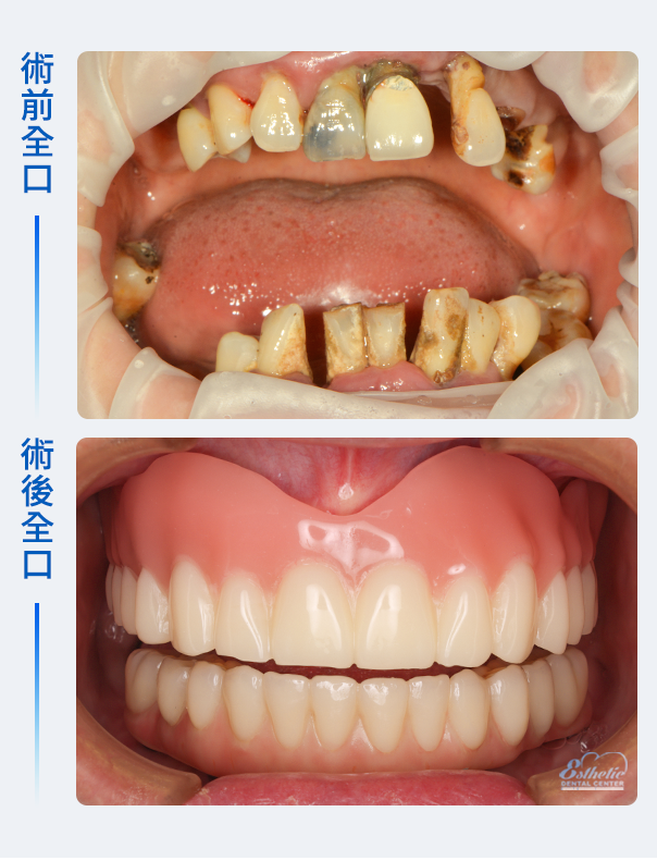 權泓牙醫鈕扣式假牙+All-on-6