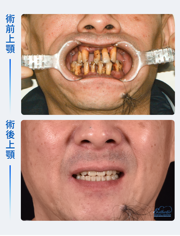 權泓牙醫上下顎All-on-6固定式全口重建療程
