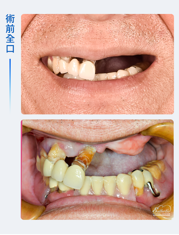 權泓牙醫Locator鈕扣式假牙案例分享