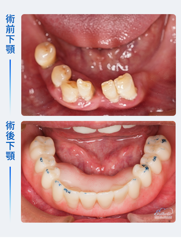 權泓牙醫Locator鈕扣式假牙案例分享
