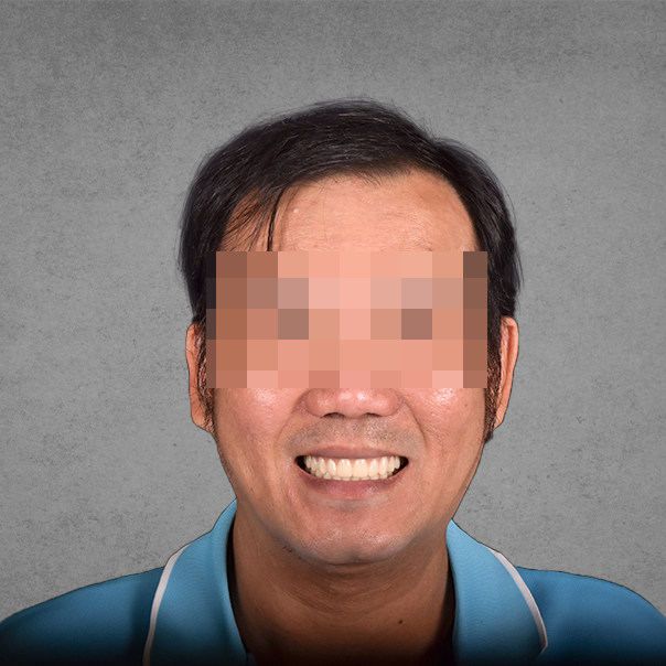 權泓牙醫Locator鈕扣式假牙案例分享