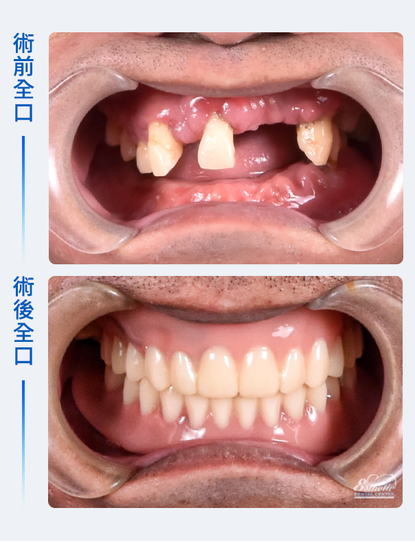權泓牙醫Locator鈕扣式假牙案例分享