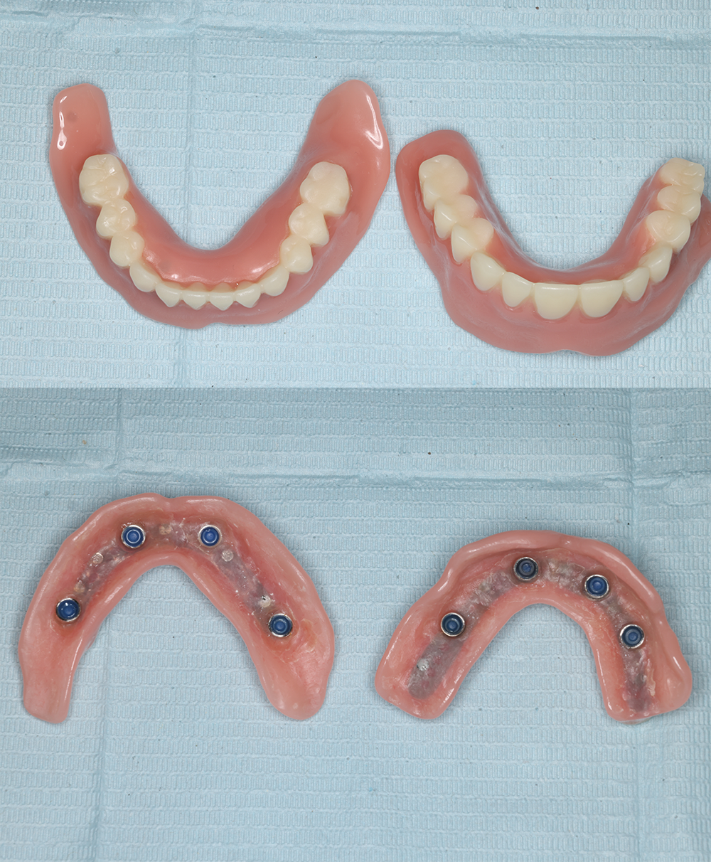 權泓牙醫Locator鈕扣式假牙案例分享