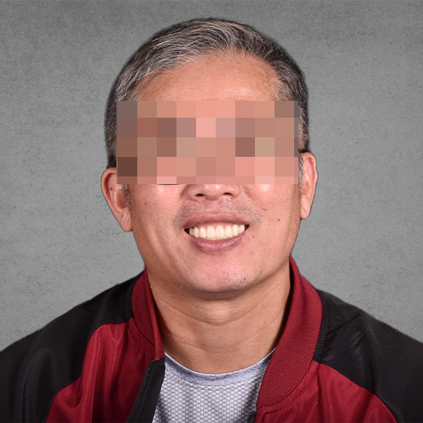 權泓牙醫Locator鈕扣式假牙案例分享