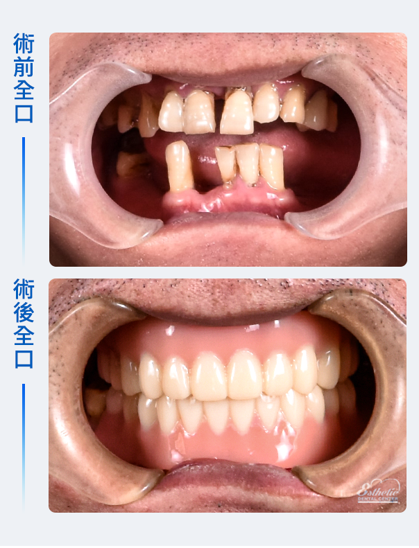 權泓牙醫Locator鈕扣式假牙案例分享