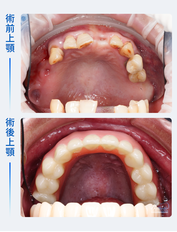 權泓牙醫Locator鈕扣式假牙案例分享