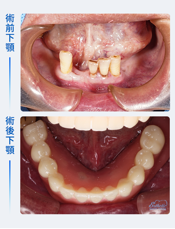 權泓牙醫Locator鈕扣式假牙案例分享
