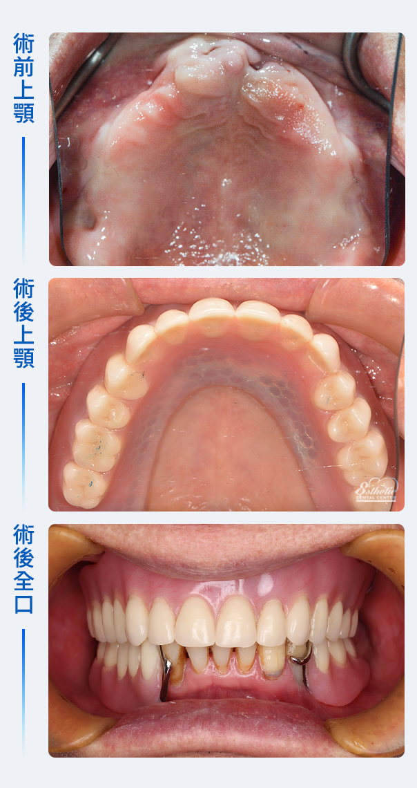 權泓牙醫Locator鈕扣式假牙案例分享