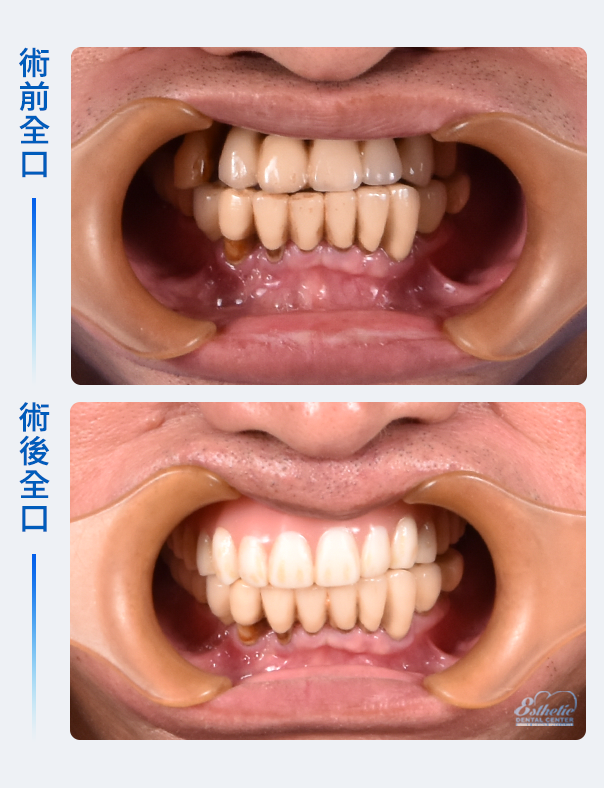 權泓牙醫Locator鈕扣式假牙案例分享