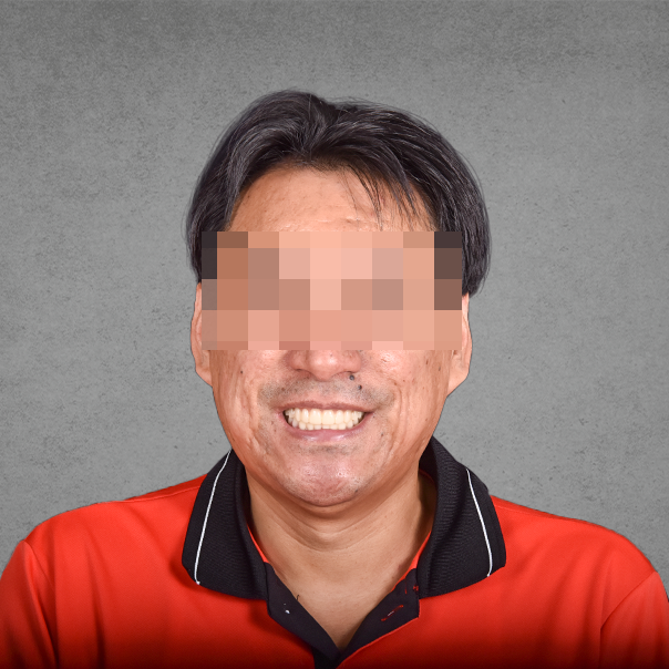 權泓牙醫Locator鈕扣式假牙案例分享