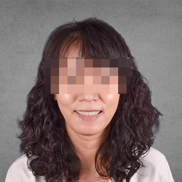 權泓牙醫Locator鈕扣式假牙案例分享