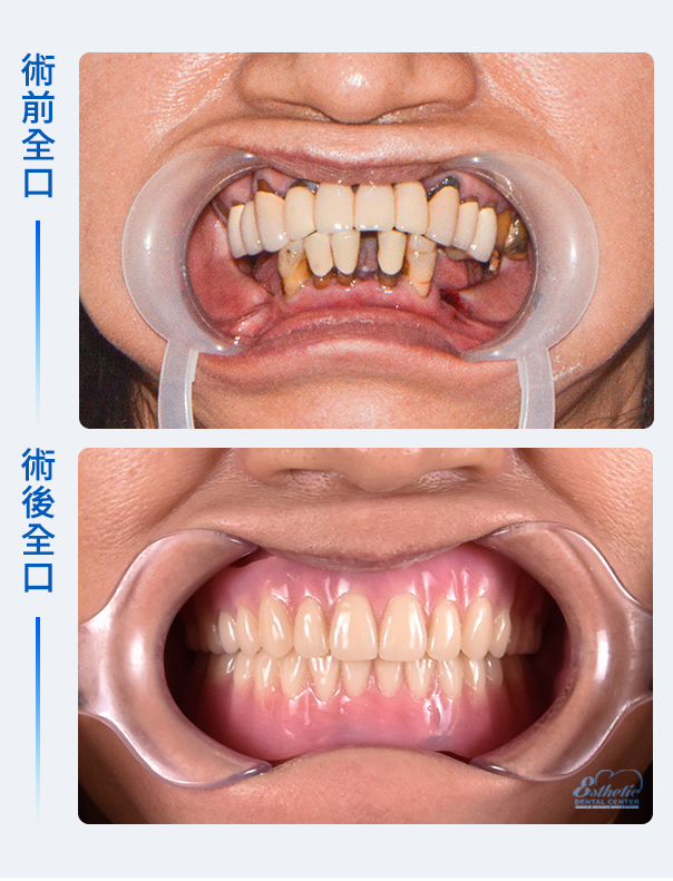 權泓牙醫Locator鈕扣式假牙案例分享