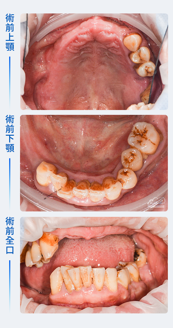 權泓牙醫Locator鈕扣式假牙案例分享