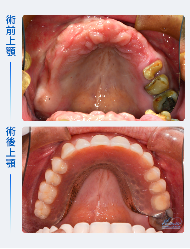 權泓牙醫Locator鈕扣式假牙案例分享